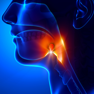 Tonsillectomy Tonsillectomy