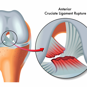 Arthroscopic ACL Reconstruction