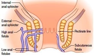 anal fistulas