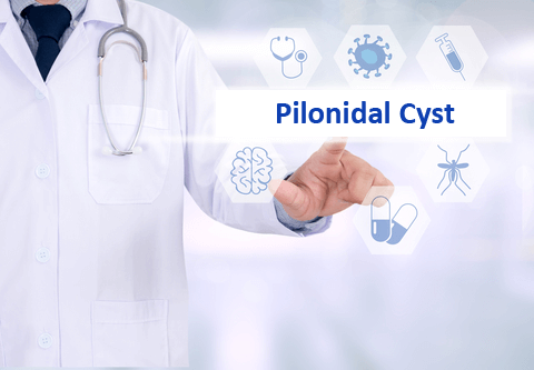 pilonidal cyst
