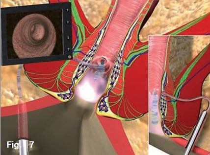 Anal Fistula Treatment - Dubai Hemorrhoids Clinic