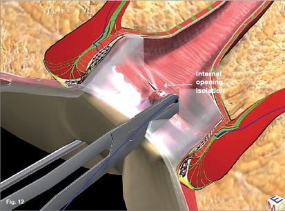 Anal Fistula Treatment - Dubai Hemorrhoids Clinic