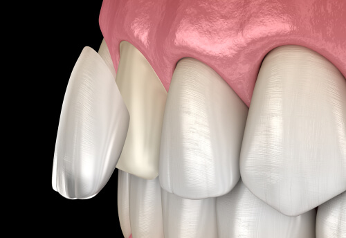 6 facts you need to know about veneer and crown - DRHC Dubai Dental Clinic
