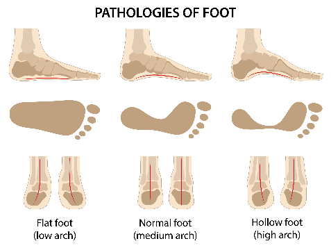 Acrute Foot - DRHC Dubai pediatric Orthopedic clinic