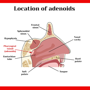 Adenoidectomy and Grommets Surgery