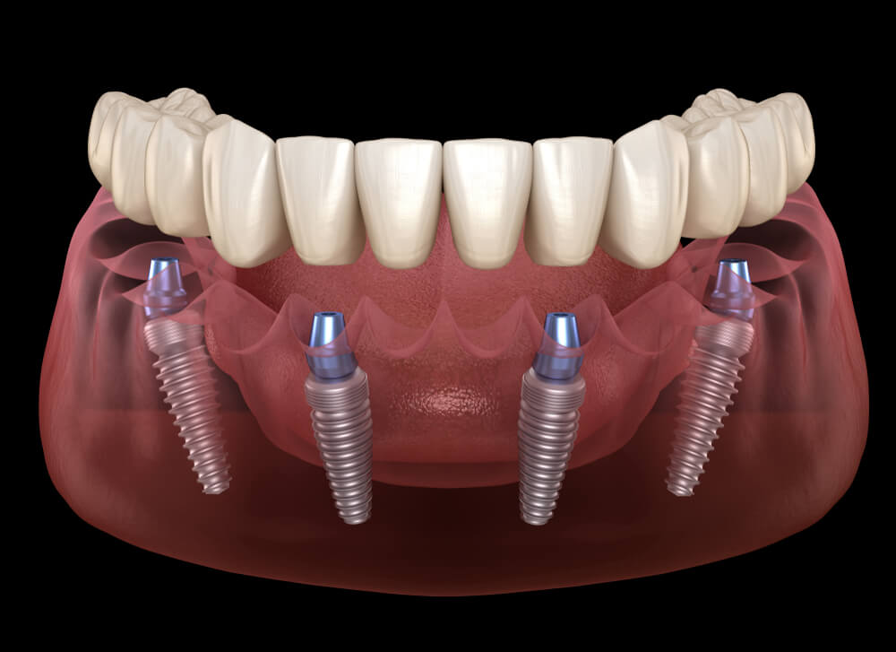 All on 4 Dental Implant