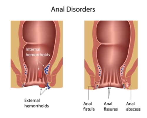 Anal Fissure  Dubai Hemorrhoids Clinic