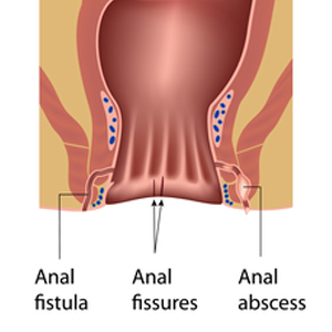 Perianal Fistula Treatment
