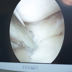 Ankle Arthroscopy