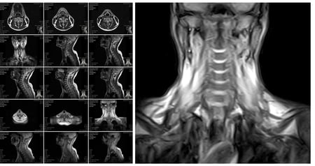 Application-Spine-Cervical