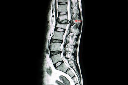 Application-Spine-Lumbar