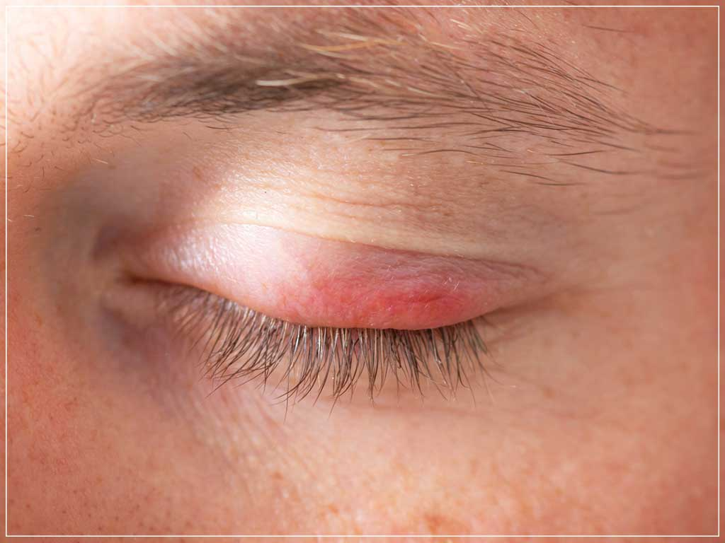 Autoimmune-Eye-Disorders-1