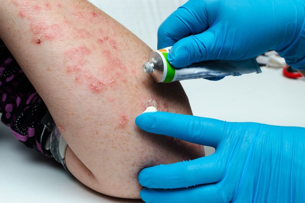 BIologic Treatment for Psoriasis