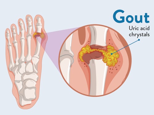 Boulder-Medical-Center-Gout2