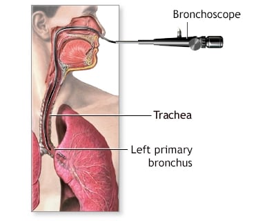 Bronchoscopy flexible