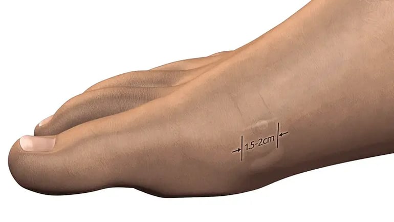 Bunion Small Incision