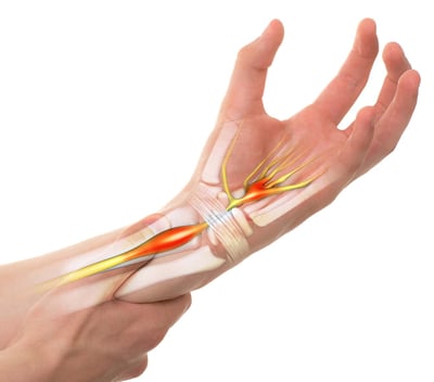 Carpal tunnel syndrome