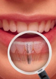 Dental Implants dubai