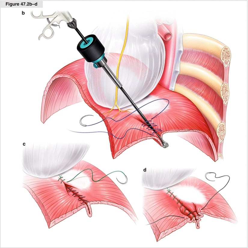 Diaphragm plication