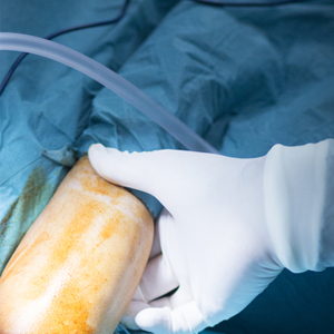 Elbow Arthroscopy Elbow Arthroscopy
