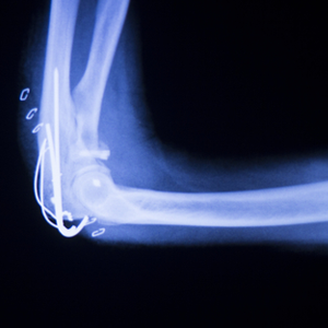 Elbow Replacement Surgery Elbow Replacement Surgery