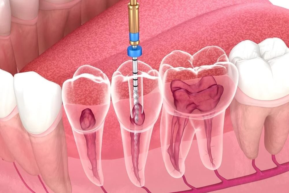 Endodontics dr rami hamed center-1