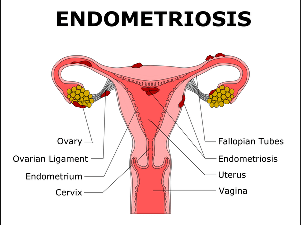 Endometriosis  DRHC Dubai Gynaecology Clinic