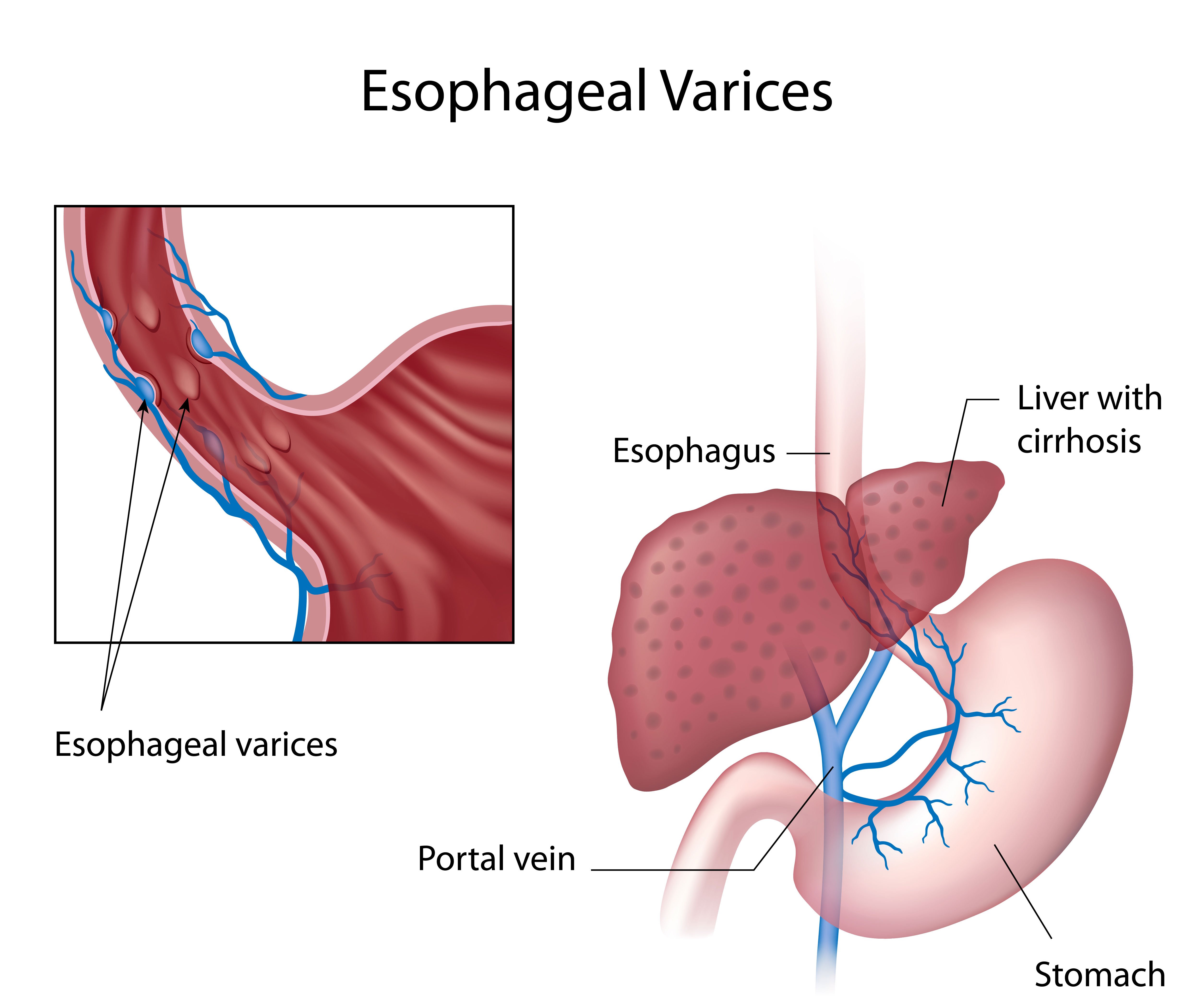 Esophageal Varices Ligation | Dubai Gastroenterology Clinic