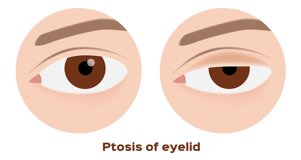 Eye Symptoms of Brain Disease  Neurology Clinic Dubai-1