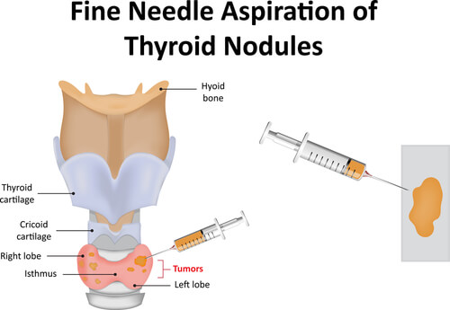 FINE NEEDLE ASPIRATION BIOPSY Dubai Thyroid Clinic