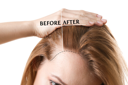 FUE Direct Hair Transplant  DRHC Dubai Hair Transplant Clinic