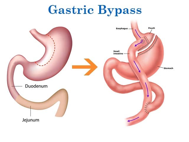Gastric Bypass Package