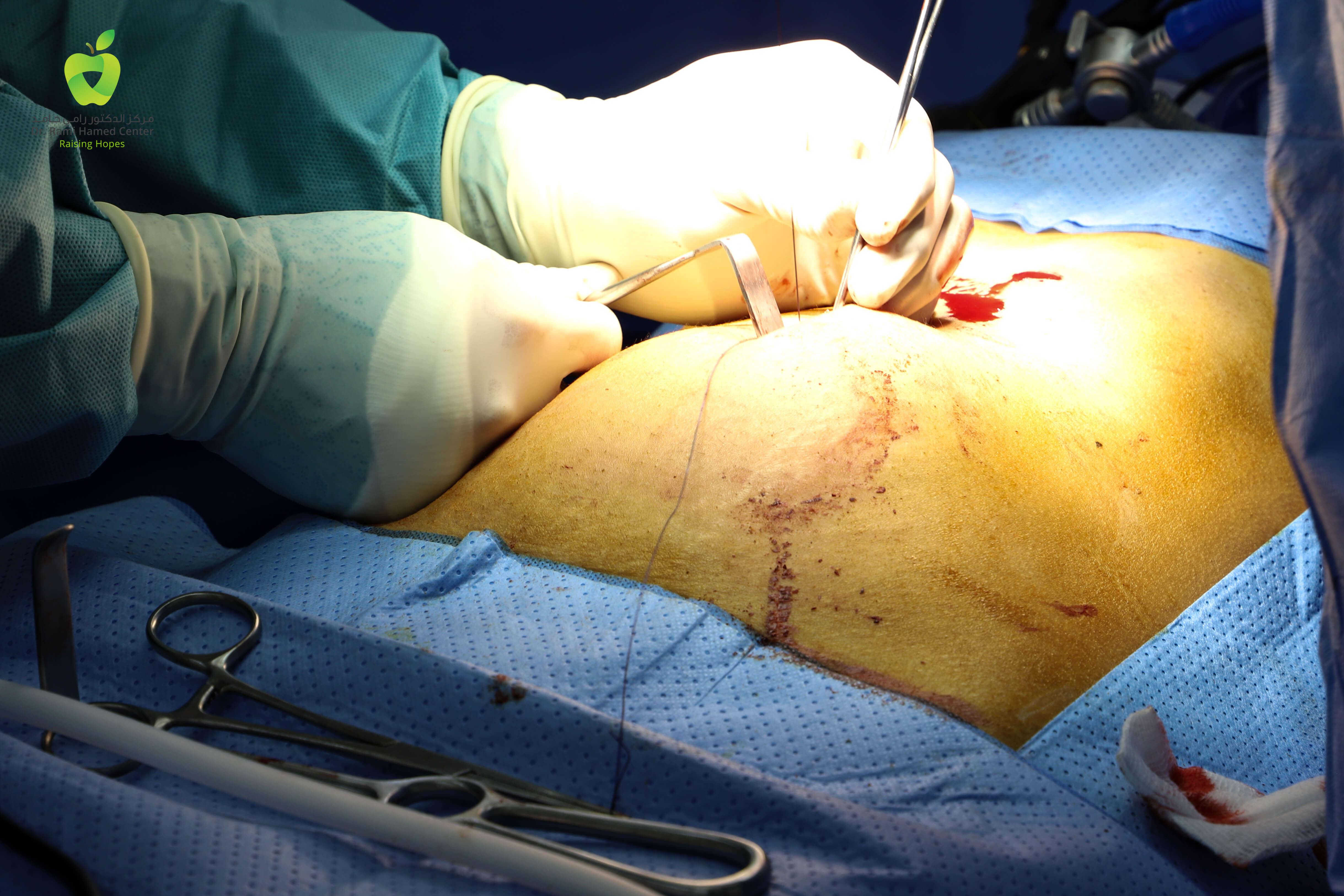 Gallbladder surgery6