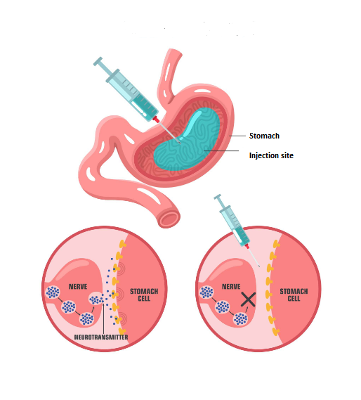 Gastric Wall injection (002)