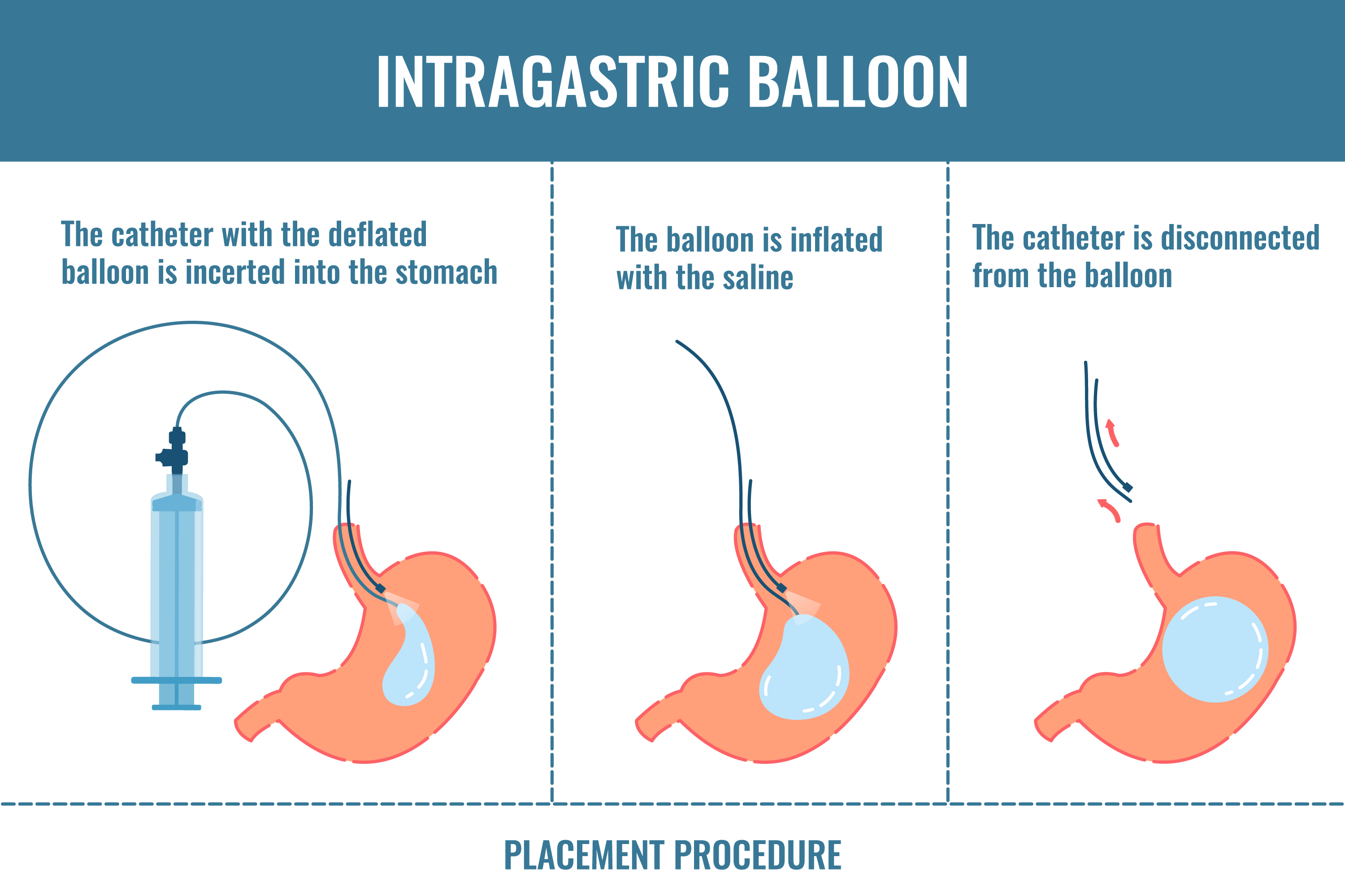 Gastric-Ballon treatment in dubai