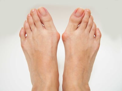 Hallux valgus  DRHC Dubai Foot and Ankle Surgery Clinic