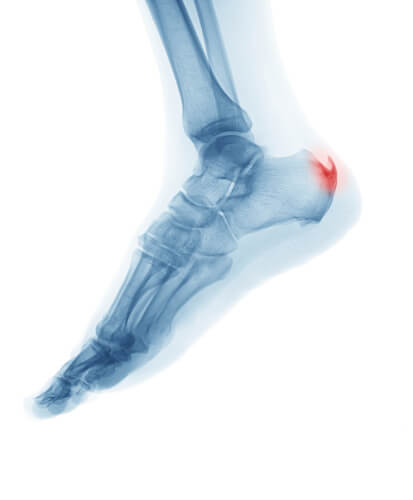 Heel pain & Achilles Tendinosis Dubai Orthopedic Clinic-1