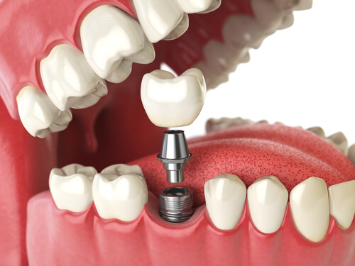 Implant Package Dubai dental clinic
