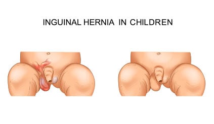 Inguinal Hernia in Kids-2