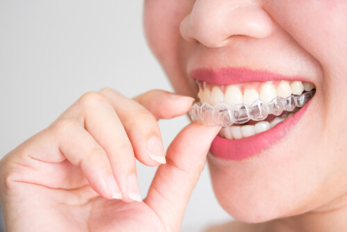 Invisalign Cost Package Dubai dental clinic