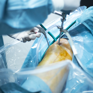 Knee Arthroscopy