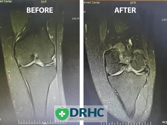 Knee Arthroscopy in Dubai DRHC