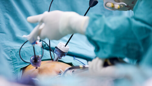 Laparoscopic Cholecystectomy - Dubai General Surgery Clinic 