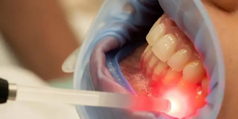 Gum Depigmentation