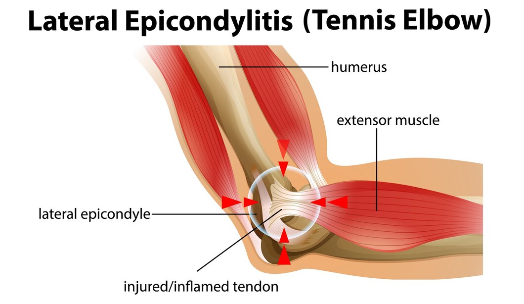 Lateral Epicondylitis of the elbow