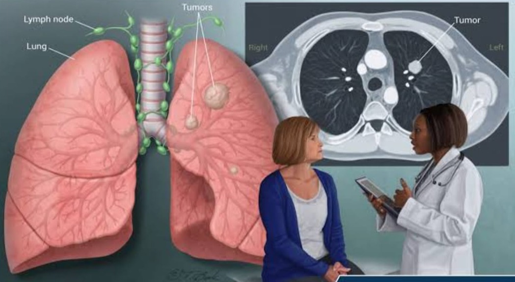 Lung cancer Surgery in Dubai