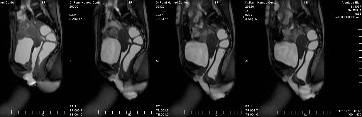 Magnetic resonance (MR) defecography