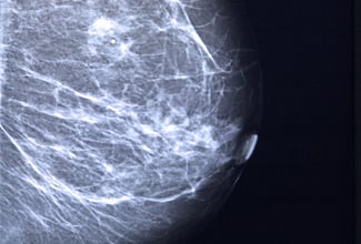Mammogram-1.jpg