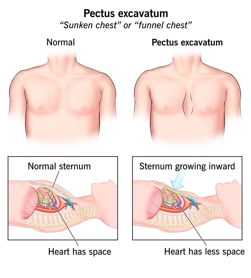 Pectus Excavatum Repair Surgery