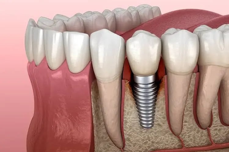 Peri Implantitis Treatment